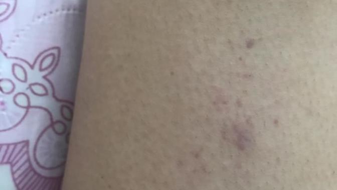 Ağda sonrası oluşan morluk nasıl geçer?
