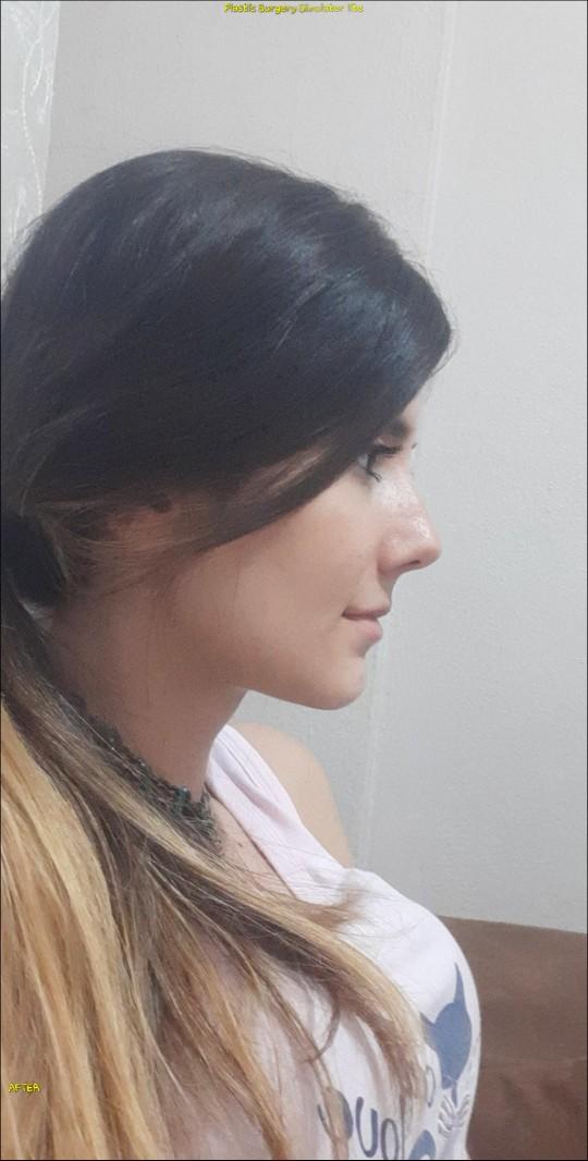 Sizce burnuma estetik yaptırayım mı?