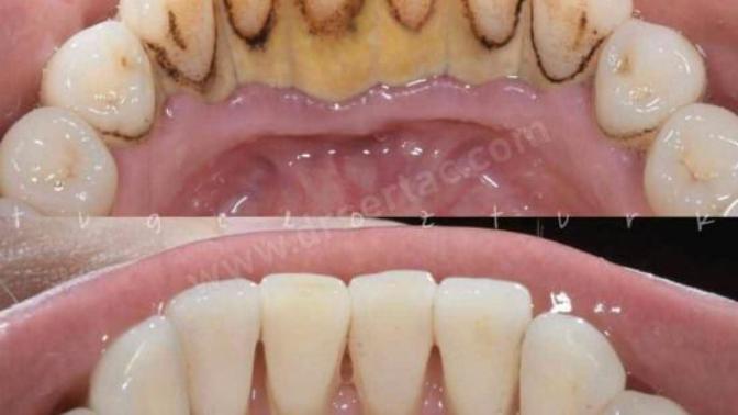 Diş taşı temizliğiniz için düzenli diş doktoruna gidiyor musunuz?