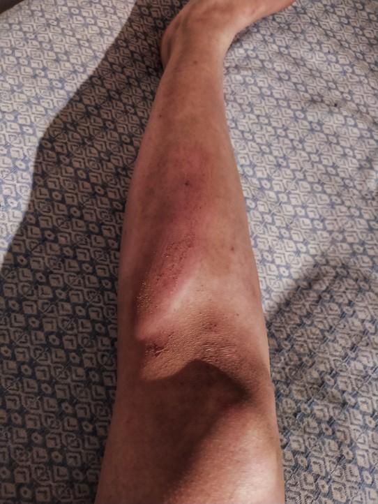 Şişlik, üstüne basamamak çıkık mı incinme mi?