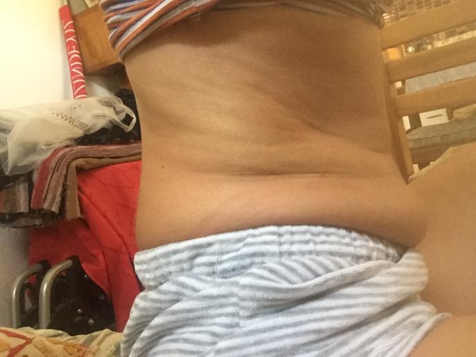 Belimdekiler selulit mi?