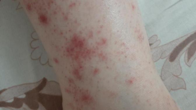 Gunes alerjisi midir nedir bu?