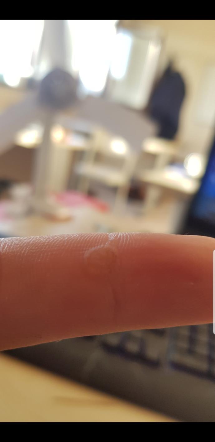 Parmaktaki siğil?