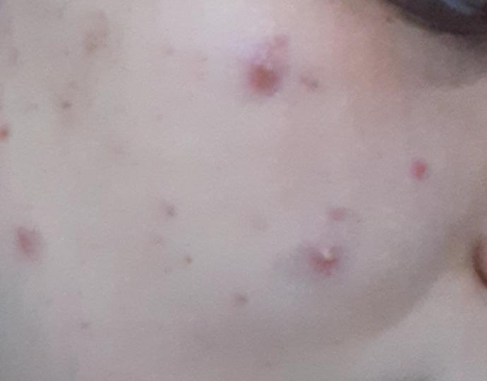 Regl döneminde çıkan sivilce için çözümleriniz nelerdir?