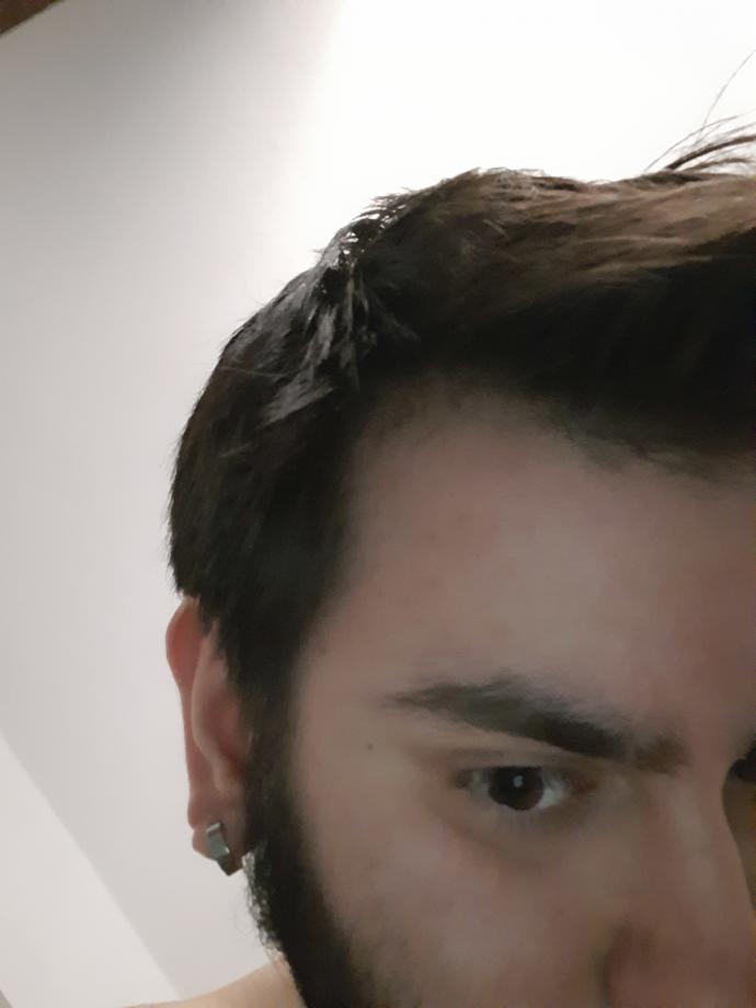 Bende saç dökülmesi var mı?
