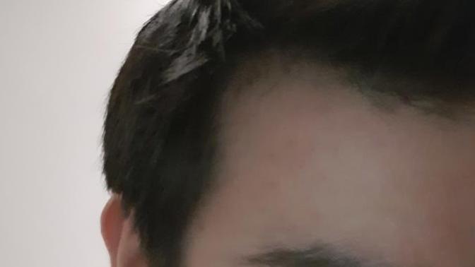 Bende saç dökülmesi var mı?