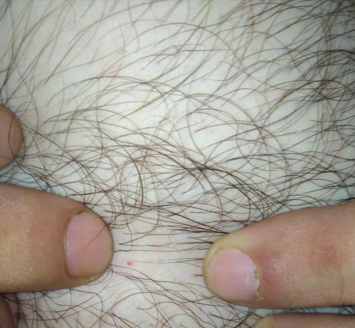 Göğsümde ki kırmızı leke sizde nedir?