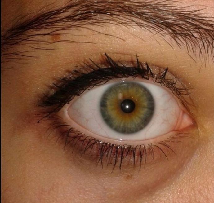 Heterochromia göze sahip olsanız lens kullanır mıydınız, yoksa bu farklılık sizi özel mi kılardı?