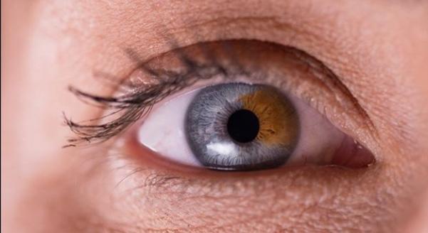 Heterochromia göze sahip olsanız lens kullanır mıydınız, yoksa bu farklılık sizi özel mi kılardı?