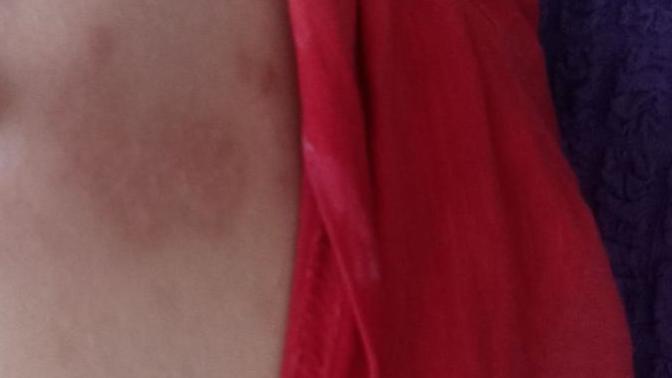 Bu yanik izi geçer mi moralim bozuk 😔?