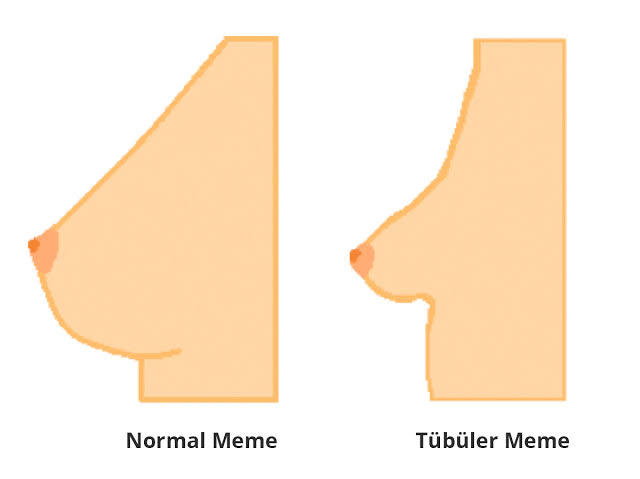 Meme şeklinde bozukluk?