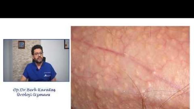 Penisimde Fordyce noktaları var biraz tırtıklı cild yüzeyi  bir  kadın buna nasıl bakar seks yapmak ister mi?