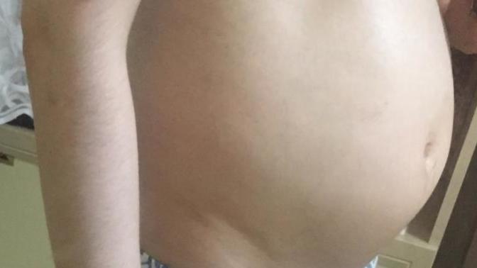 Bu göbeği nasıl eriteceğim , vücuduma yük geliyor artık (Resimli)?