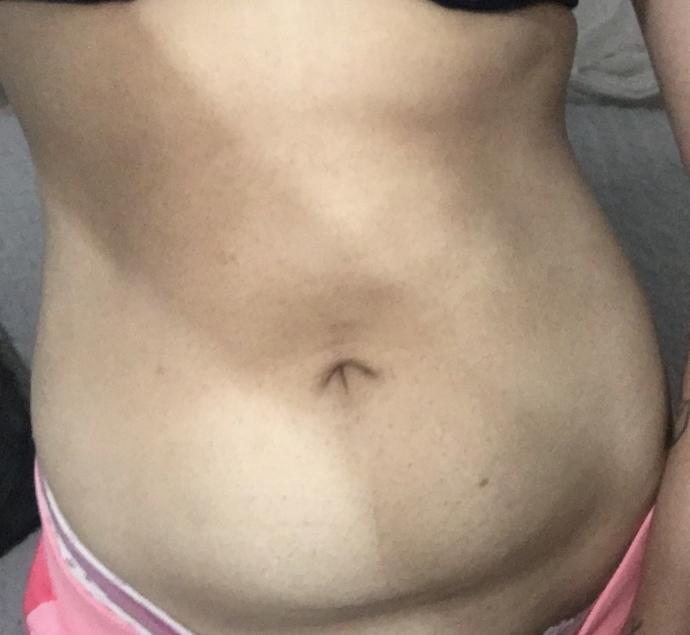 Göbeğim fotoğraftaki gibi 20 kilo verdim göbeğim kaldı geriye sadece sizce sporla düzelir mi ve sarkıyor mu