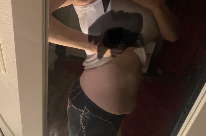 Bikere doğum yaptım,62 kiloyum (fotolu) sizce ağırlık ile düzelirmi karnım ameliyat şartmı?