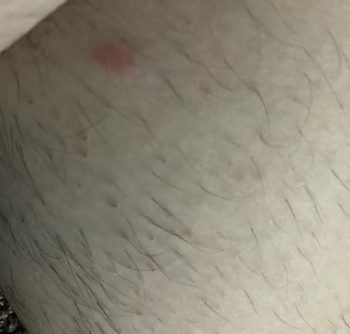 Sivrisinek mi pire ısırığı mı?