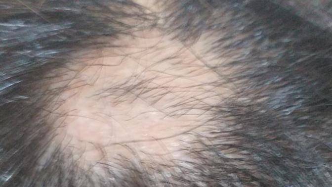 Saçım birden açılmaya başladı, sebebi ne olabilir?