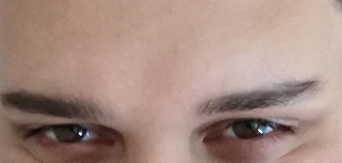 Hunter eyes nedir nasıl yapılır?