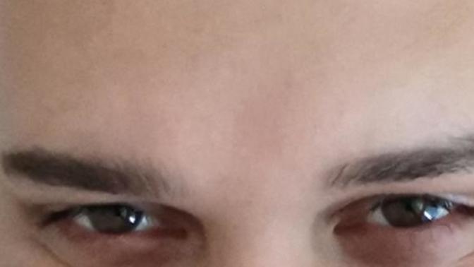 Hunter eyes diye tabir edilen derin çekik göz gibi olan göz şekli resimdeki gibi mi oluyor?