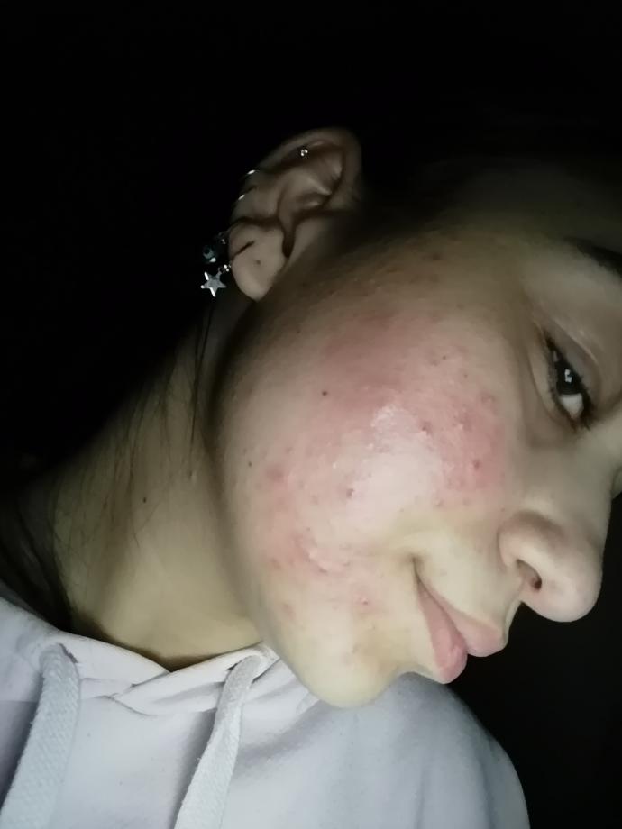 Yüzümün son hali. Tipim için kusura bakmayın. Ağladım çünkü sjzhshxk