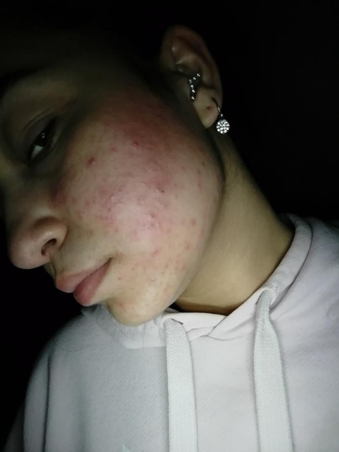 Sivilcelerim çok kötü, roaccutane tedavisi etkili olur mu?