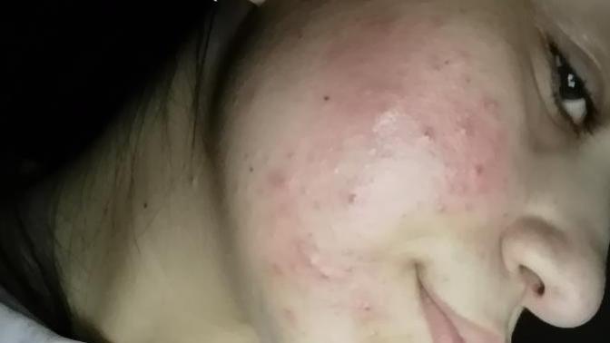 Sivilcelerim çok kötü, roaccutane tedavisi etkili olur mu?
