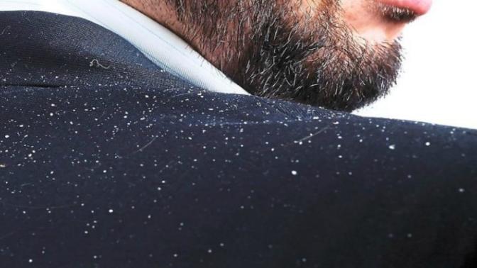 Erkek için En İyi Kepek Önleyici Şampuan Hangisi?