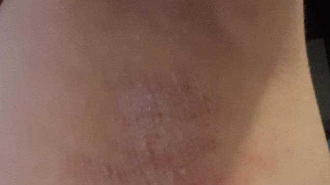 Koltuk altimda, bikini bolgemde ve ensemde egzema var. Kullandigim ilaclar ise yaramiyor. Gittiginiz iyi bir doktor var mi?