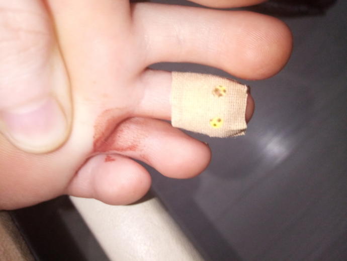 Ayak parmağımı masanın paslı ayağı kesti ne yapmalıyım (detay) ?