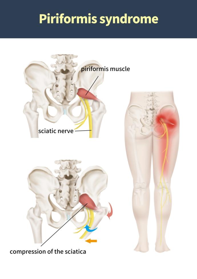 Piriformis sendromu, eğer orada ağrınız varsa mutlaka geçecektir çnemli olan doğru tedaviyi bulmak