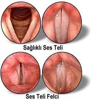 Kızlık zarıma birşey olmuş mudur?