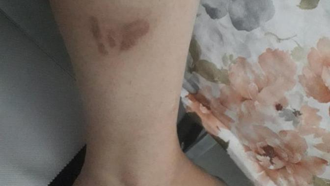 Bacağımdaki yanık izi için dövme önerir misiniz?