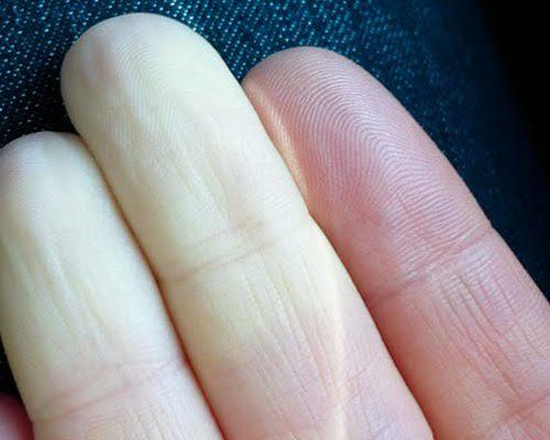 Raynaud Hastalığı Olan Var Mı?