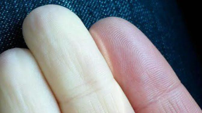 Raynaud Hastalığı Olan Var Mı?