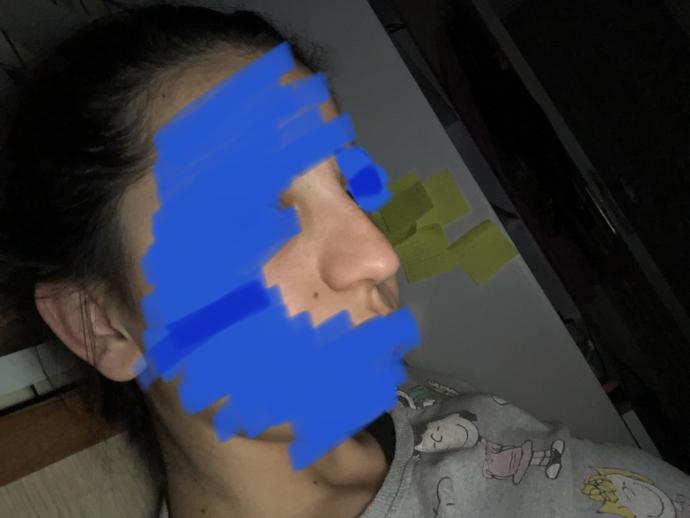Burnum çok çirkin, estetik yaptırsam düzelir mi?
