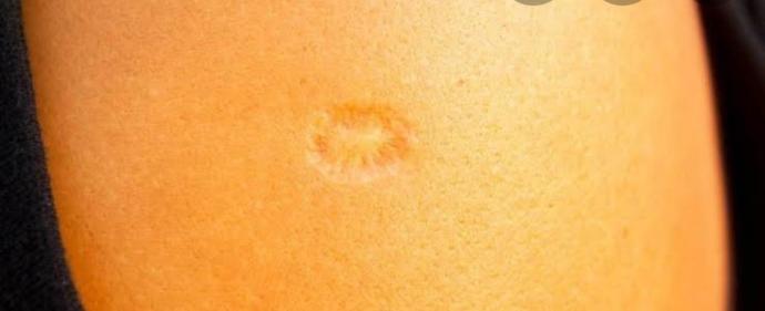Sol kolunuzda aşı izi var mı?