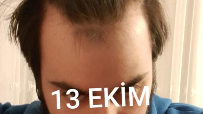 Genetik saç dökülmesi mücadelesinde aşama kaydetmiş miyim?