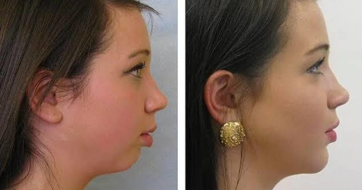 Alt çene geriliği için Jawline dolgusu ne kadar etkili? KizlarSoruyor