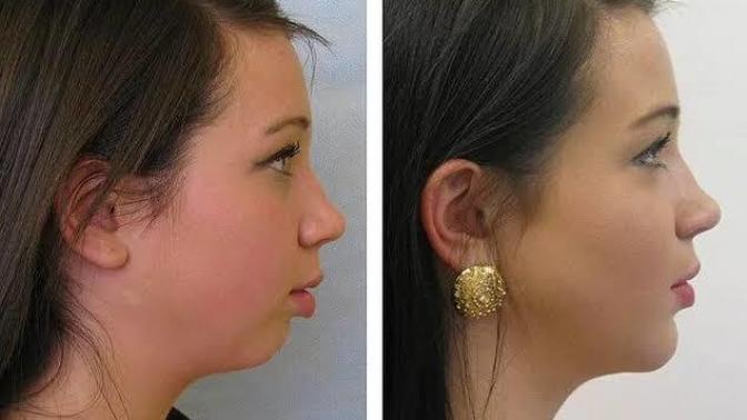 Alt çene geriliği için Jawline dolgusu ne kadar etkili?