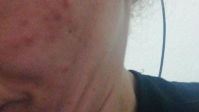 Bu sivilceler nasıl geçer?