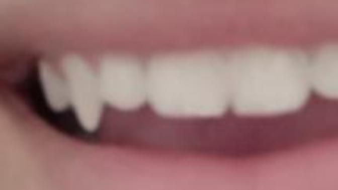 Vampire benzeyen dişlerim var, diş teli takarsam düzelir mi?
