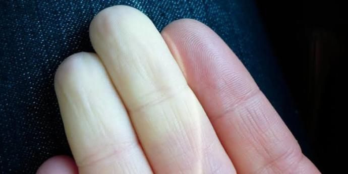 Raynaud Olan var mı veya Geçen?