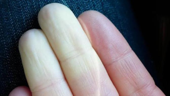 Raynaud Olan var mı veya Geçen?