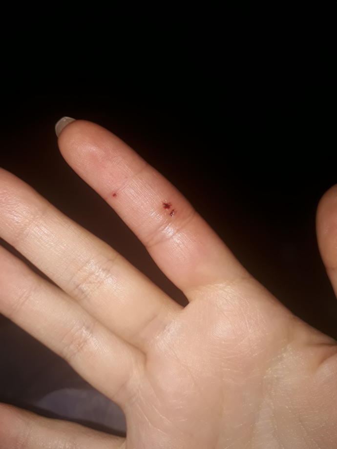Sokak kedisi elimi ısırdı, kuduz aşısı oldum ama elim gittikçe şişiyor? Yaşayan var mı?