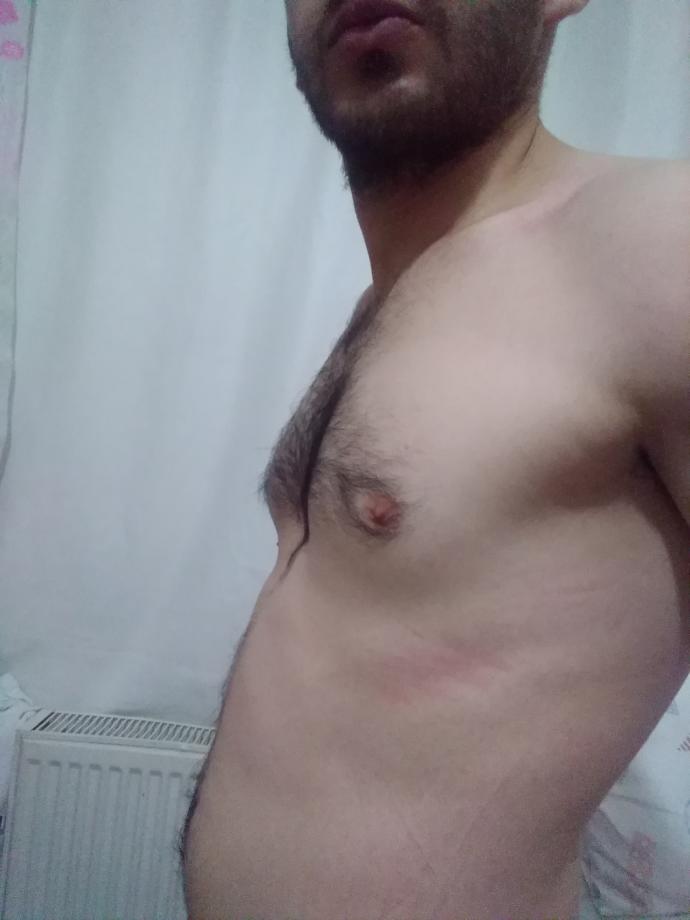 Arkadaşlar sizce göğüslerimde jinekomasti var mı ve tek çözümü ameliyat mıdır?
