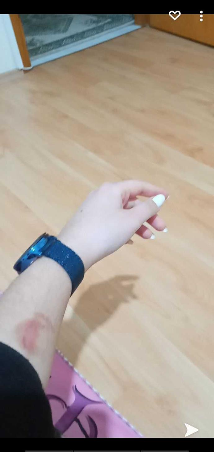 Yanık İzi geçer mi?