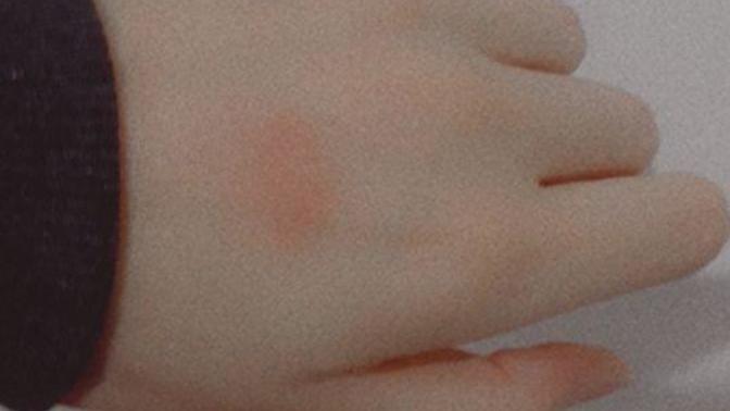Elimi duvara çarptım morardı. Ne yapacağım şimdi?