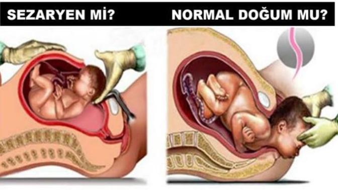 Sezaryen doğum mu yapacaksınız normal doğum mu, neden?