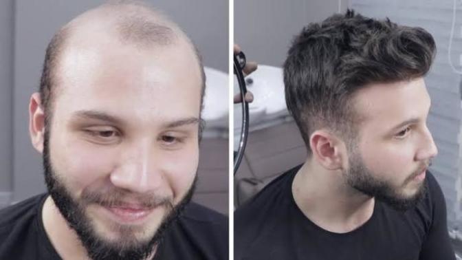 Protez Saç Kullanan Var Mı?