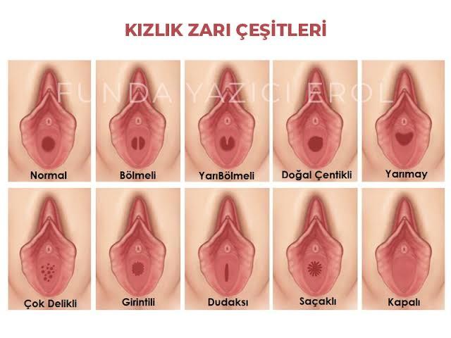 Ilişkide kızlık zarı çeşitlerinin bir öne var mıdır?